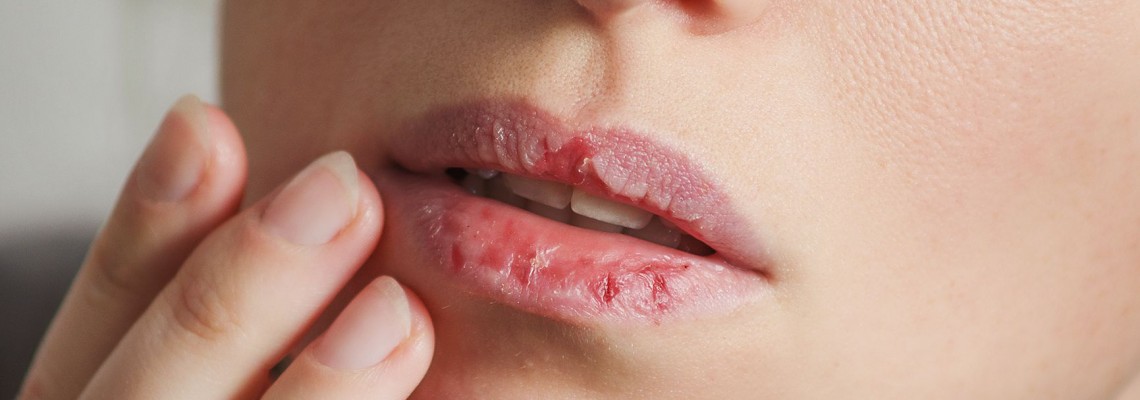 TIPS MENGATASI BIBIR KERING
